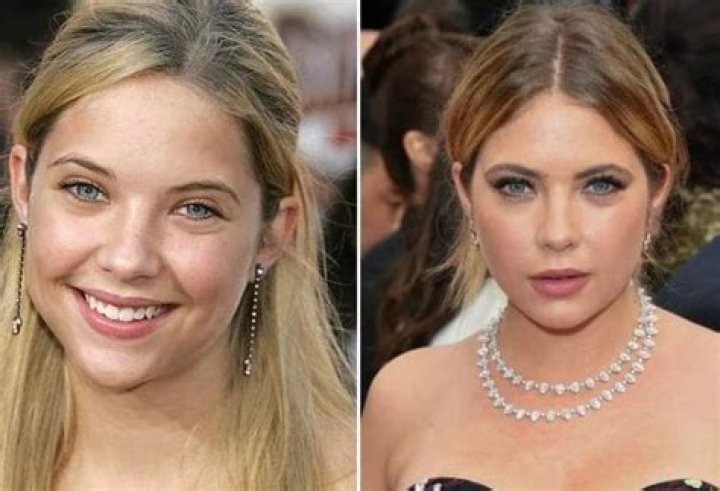 Ashley Benson Plastic Surgery: Did She Go Under the Knife?&nbsp;