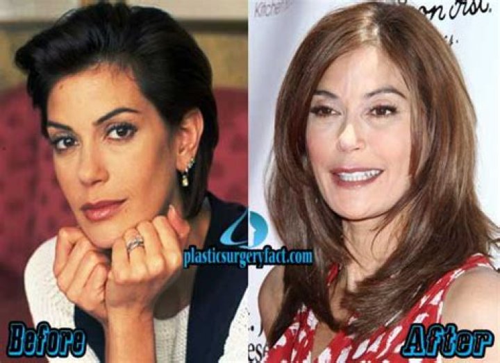 Teri Hatcher Plastic Surgery Before and After